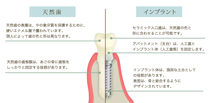 インプラント画像