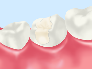 コンポジットレジン（保険適用）