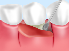 歯周外科手術