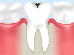 エナメル質のむし歯