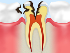 神経に達したむし歯