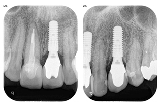 術後のデンタルレントゲン写真